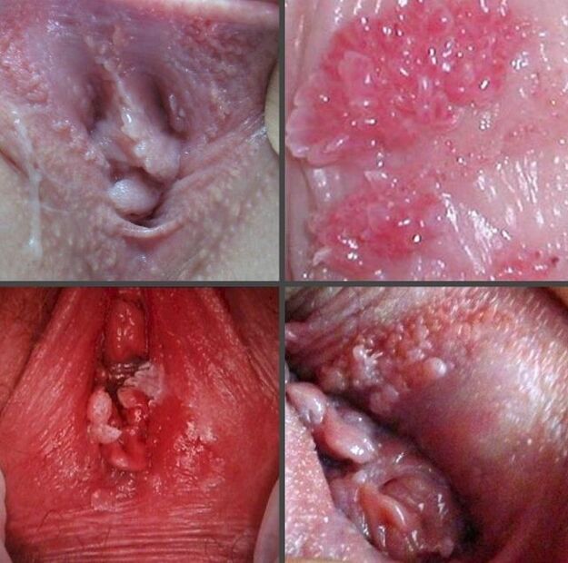 Gros plan sur les papillomes du vagin