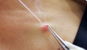élimination des papillomes sur le corps avec un laser